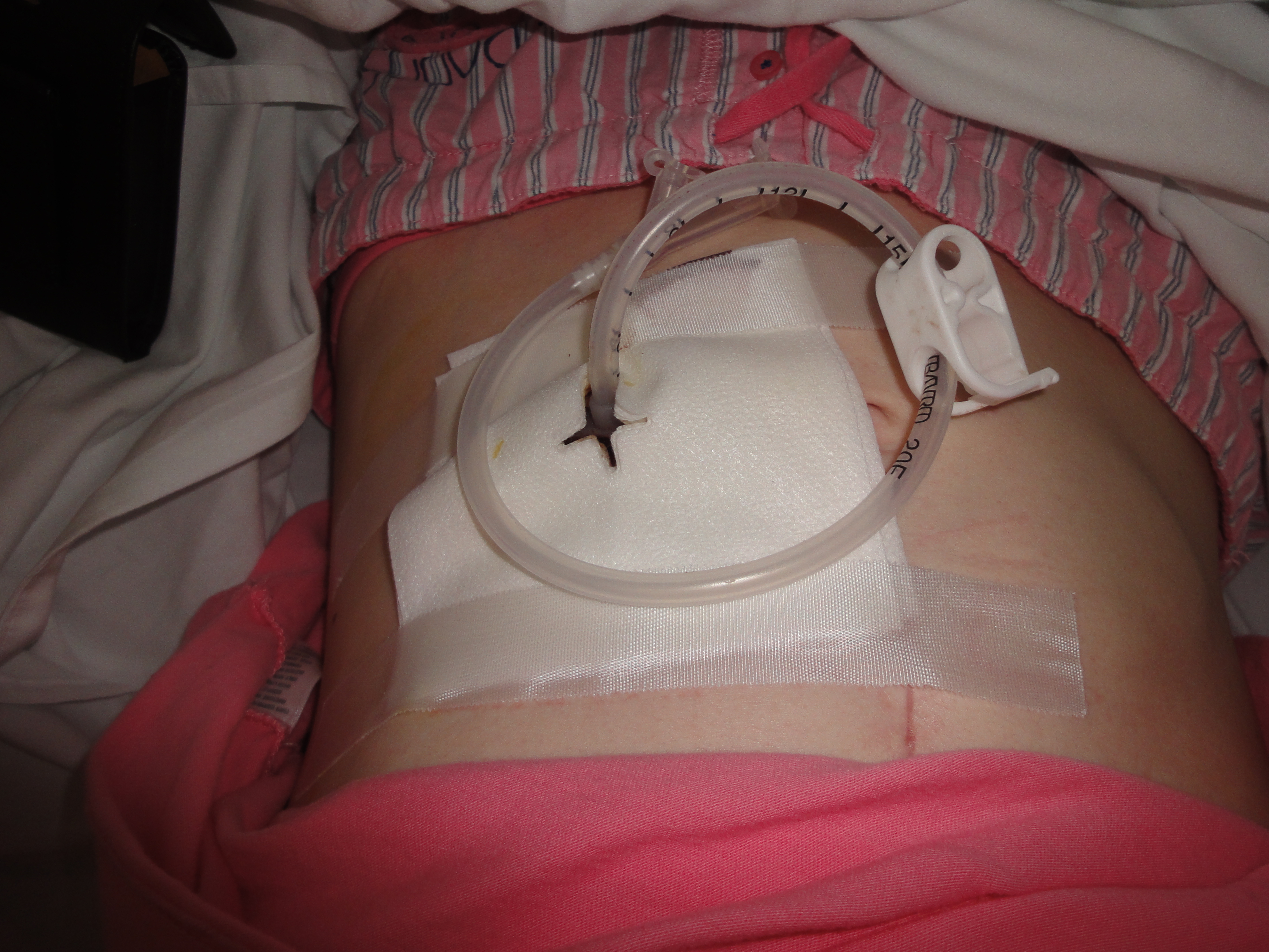 Living with Gastroparesis » Tubes